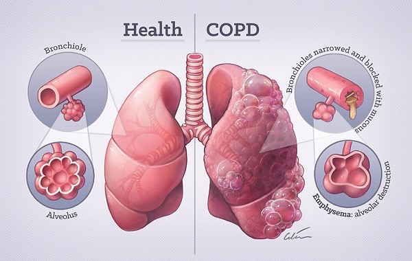 khi-phe-thung-va-viem-phe-quan-man-tinh-trong-benh-copd-1762481002.jpg